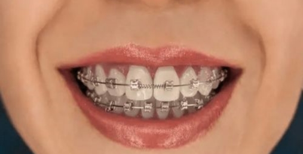 正畸治疗前您要做什么