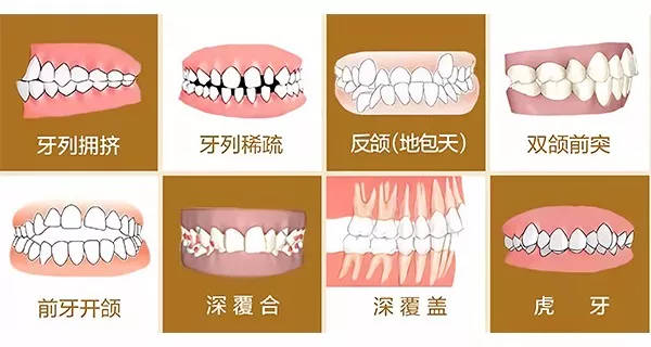 牙颌畸形是怎样的