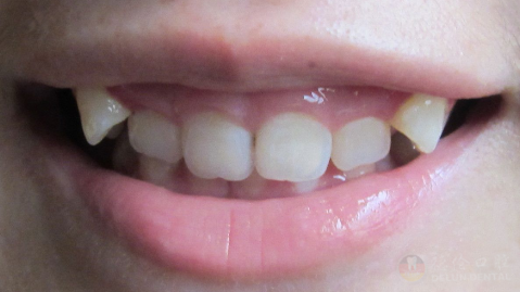 牙齿发育异常有哪些