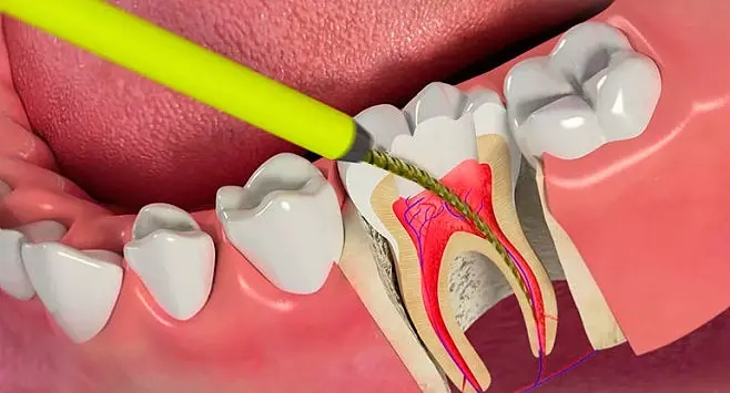 为什么根管治疗后的牙齿容易发生劈裂