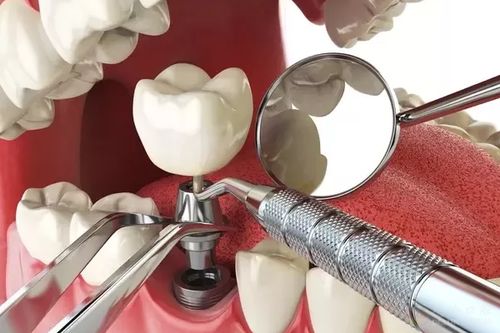 种植牙是缺牙人群的首选方法吗