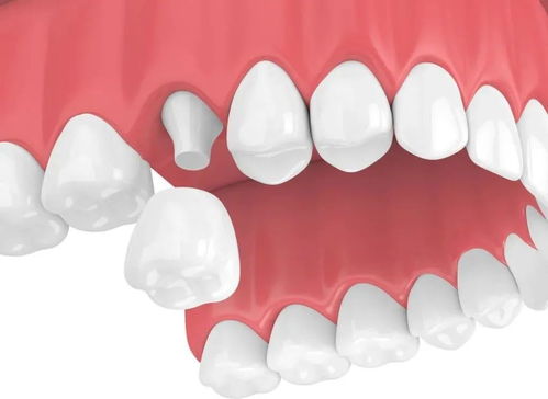 镶牙怎么选择义齿 怎么保护义齿