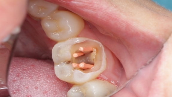 根管治疗成功的标准是什么