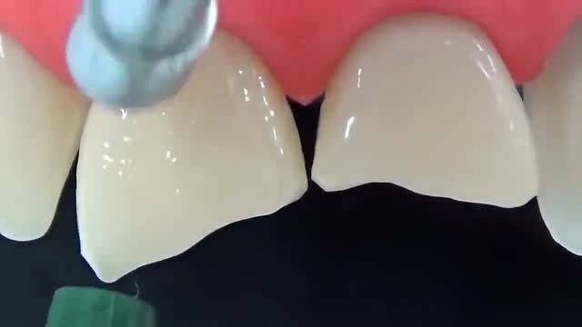 牙齿修补后可能会出现哪些问题