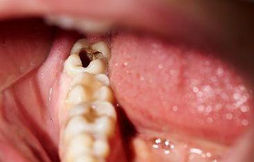 龋齿是怎样发生的