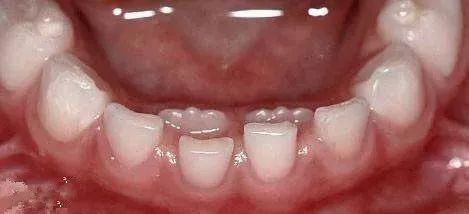 替牙期的异常现象是什么