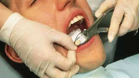 拔牙后的注意事项是什么