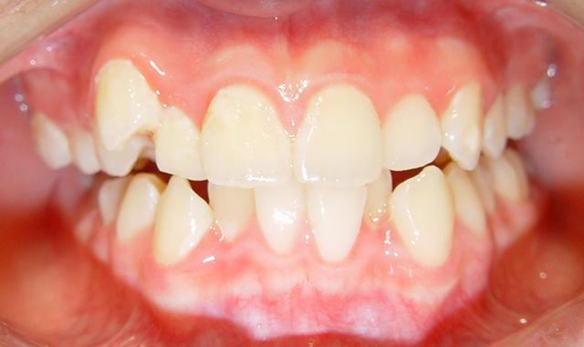 牙齿排列不整齐的严重性