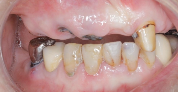 不良假牙会造成什么后果