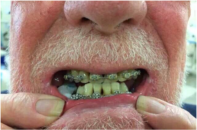 老年人错颌畸形的原因是什么