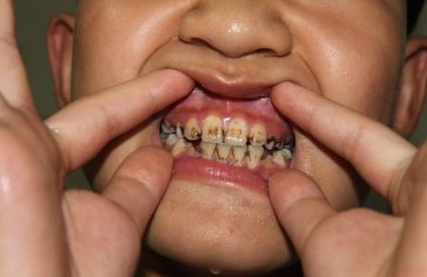 常见的牙齿异常着色的原因是什么