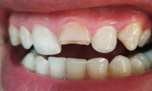 牙体缺损的修复是什么样的