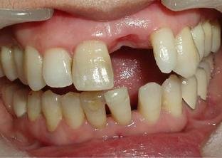 缺牙对咬合系统的影响有哪些