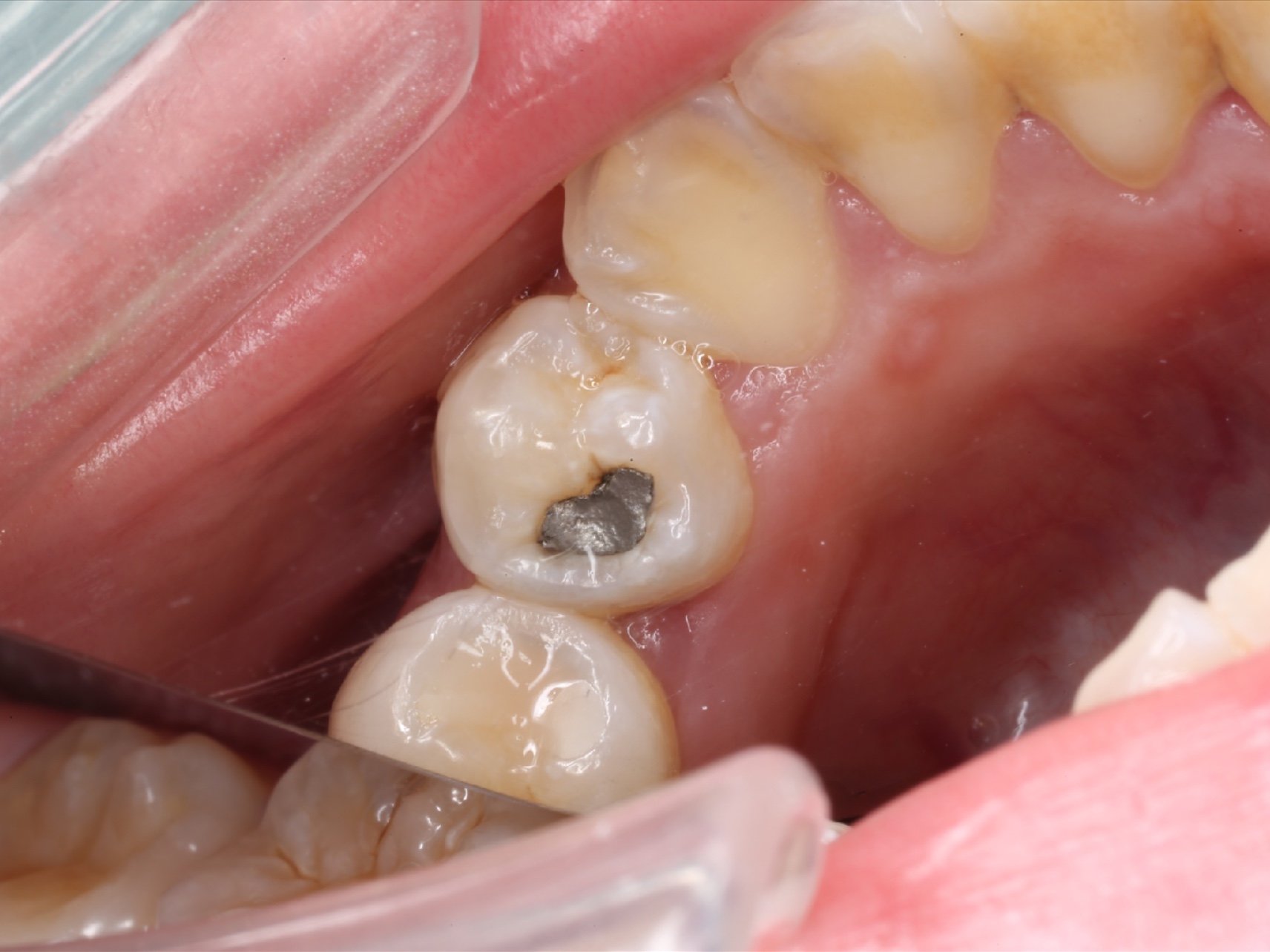 银汞合金补牙安全吗