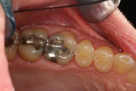 补牙材料充填时要注意的六大问题