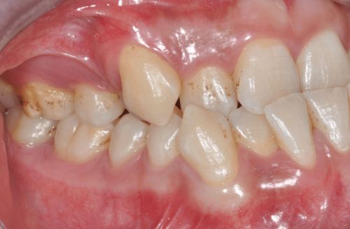 牙列拥挤的原因是什么