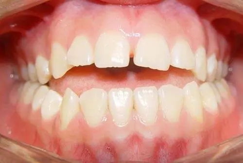 需要正颌外科手术的牙颌畸形有哪些