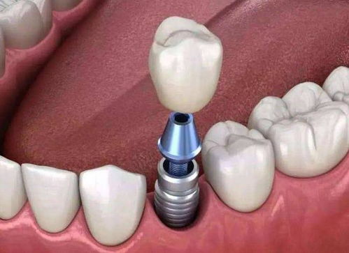 种植手术的适应证是什么