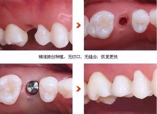 种植修复方案是怎么设计的