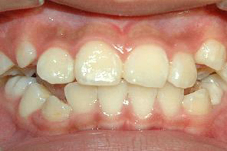 牙齿形态异常的原因是什么