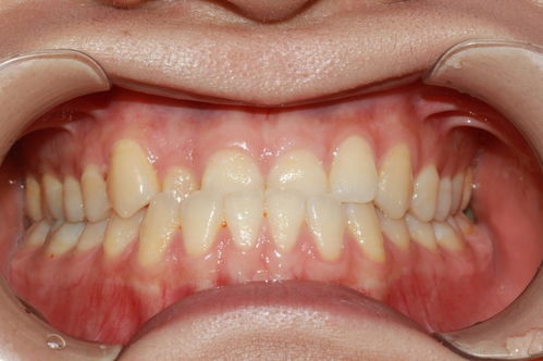 需要手术治疗的牙列不齐有哪些