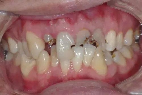 保护牙齿的六大误区是什么