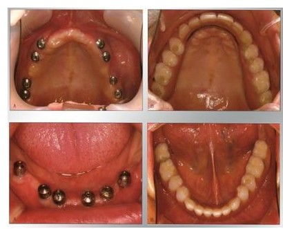 全口牙缺失的种植是什么