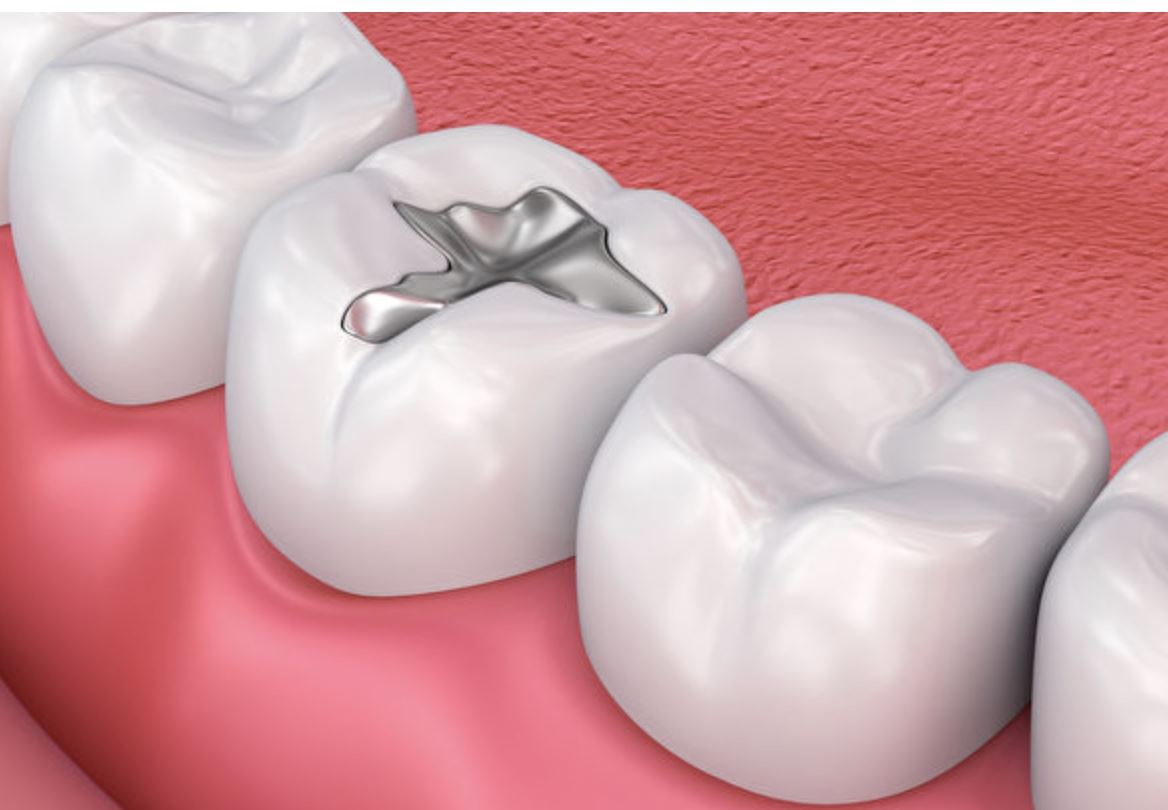 治疗龋齿和牙体缺损是怎样选择修复材料的