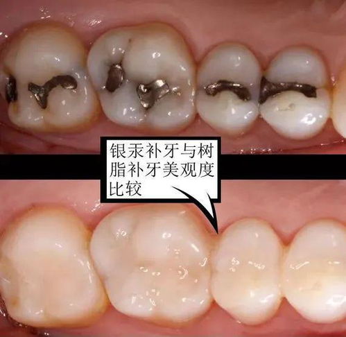 补牙是怎么回事 什么叫树脂充填