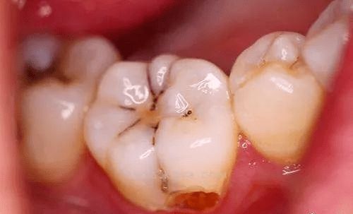 什么是窝沟封闭 什么时候做合适 会伤牙吗