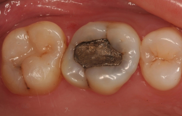 补过的牙齿能用多久