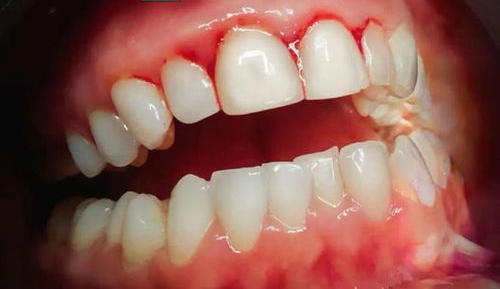 牙痛的原因及治疗