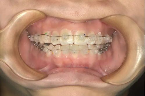 正畸治疗中牙龈组织的变化