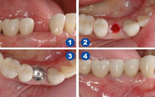 种植牙修复的条件是什么