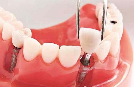 种植义齿的适应证是什么