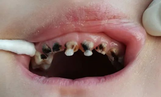 儿童乳牙龋病的预防原则是什么