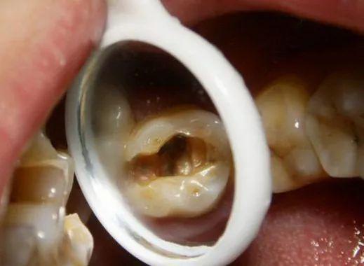 治疗龋齿在补牙之前为何要磨牙