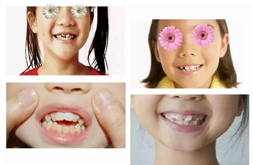 牙颌畸形对儿童健康有什么危害