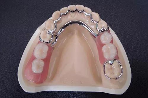 可摘局部义齿的组成与优缺点