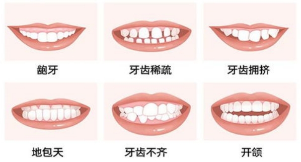 牙颌畸形要怎么预防