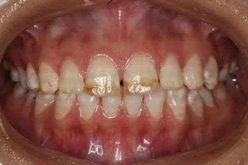 牙齿的色泽是由什么引起的