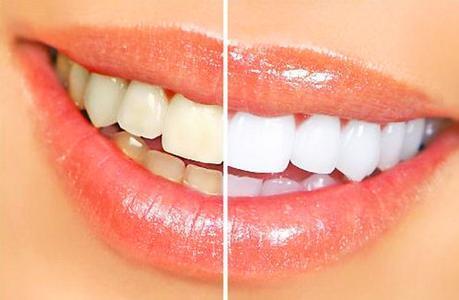 如何预防变色牙