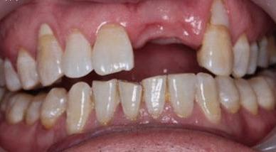 牙齿修复前准备与处理