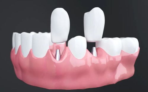 种植修复后的常见问题及其处理