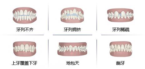 牙颌畸形的矫治方法有哪些