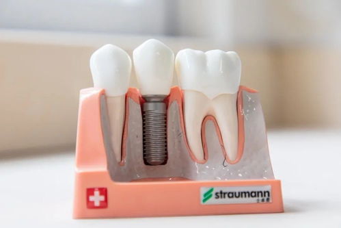 种植牙手术如何进行