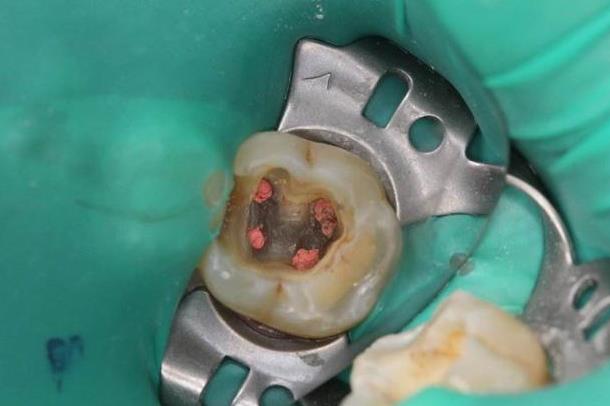 窝洞充填常见问题及处理方法