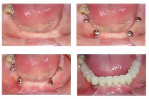 全牙列缺失后的组织变化
