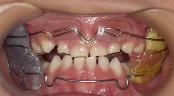 什么是牙颌畸形的早期预防