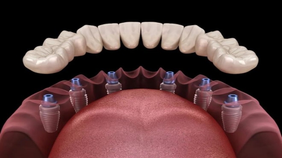 种植牙的手术与修复过程是什么样的